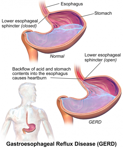 image of GERD