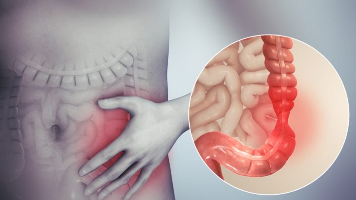 image of IBS