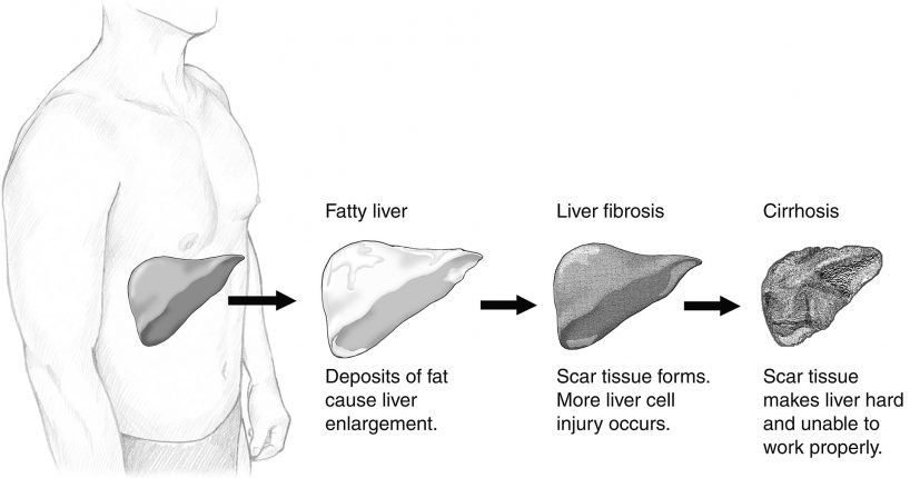 image of NAFLD